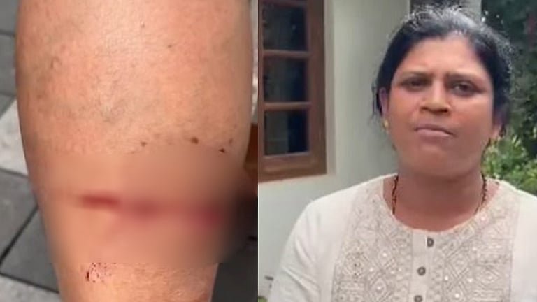 വോട്ടുതേടിയെത്തി; സ്ഥാനാർത്ഥിയെ വളര്‍ത്തുനായ ഓടിച്ചിട്ട് കടിച്ചു…